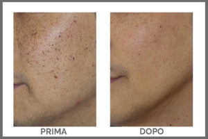 Macchie Sole Melasma Smacchiatura Viso Corpo Laser Santeufemia